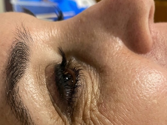 Tratamiento facial — antes